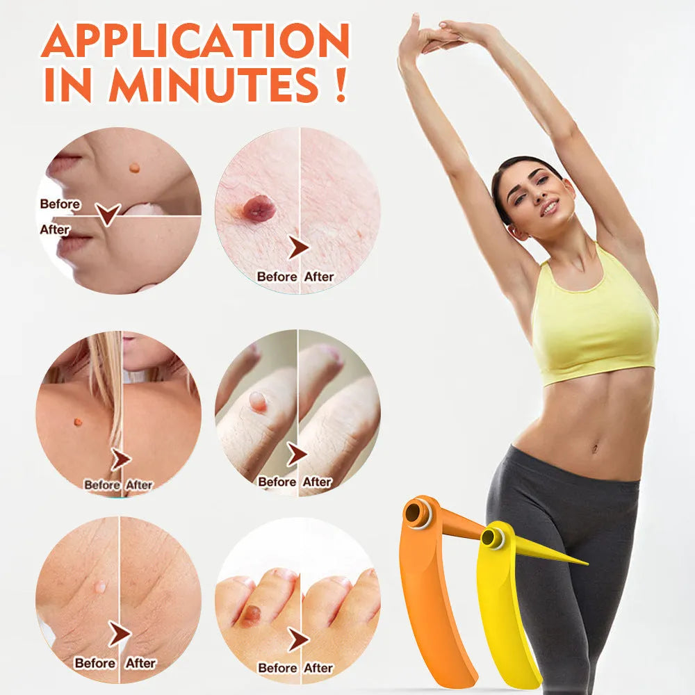 Orange mole removal tool kit with two devices, cones, rubber rings, alcohol swabs and repair sticker