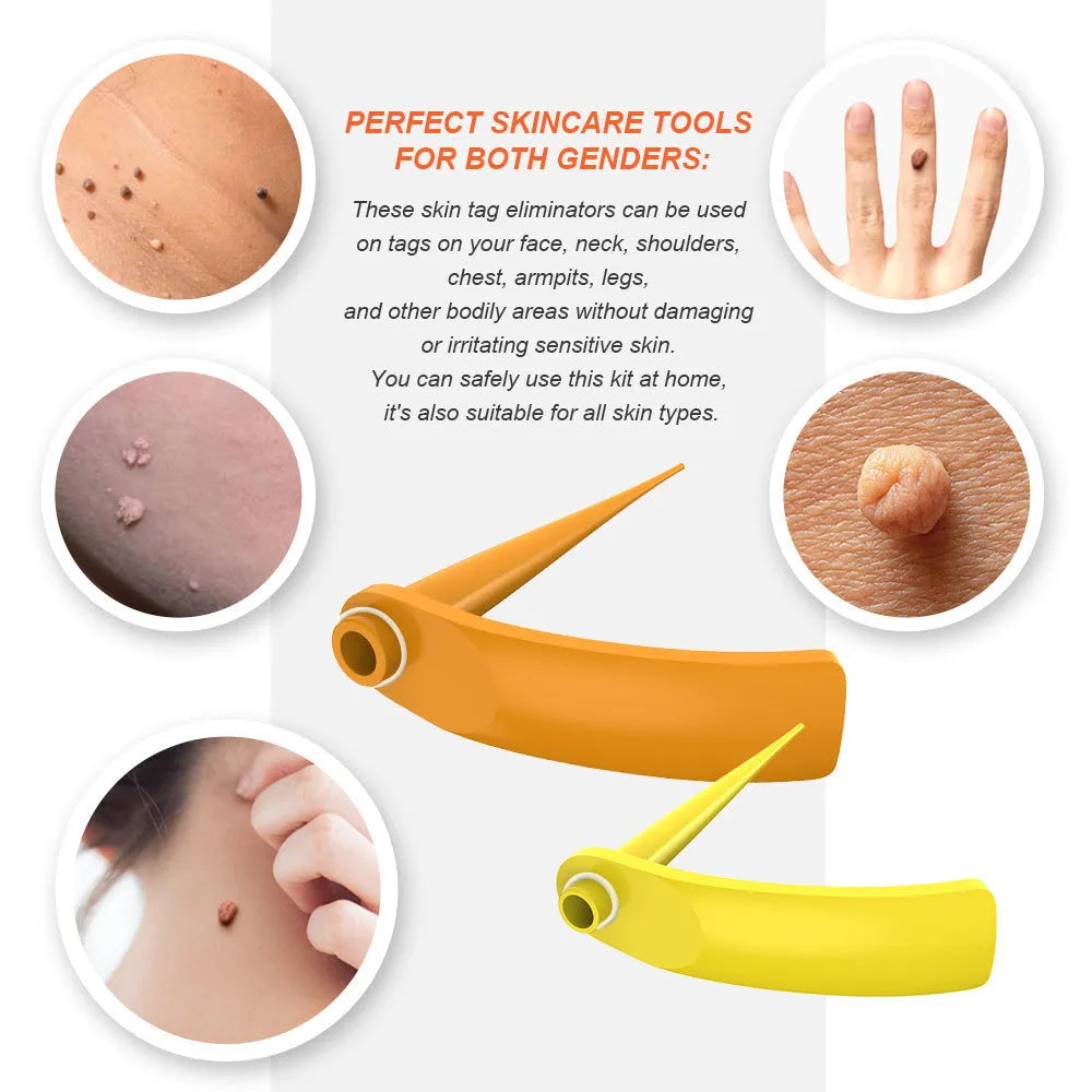 Orange mole removal tool kit with two devices, cones, rubber rings, alcohol swabs and repair sticker